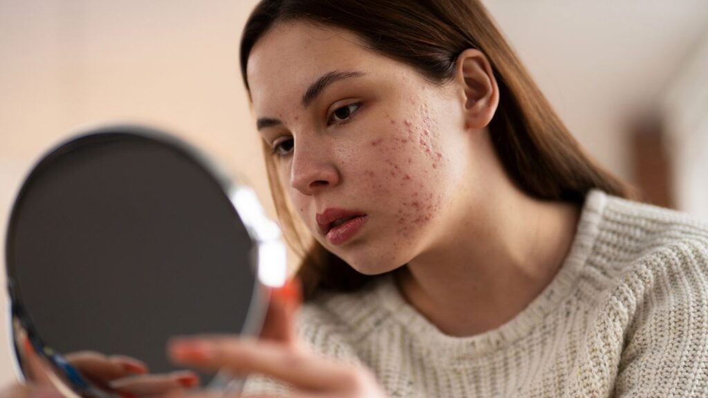 cystic acne