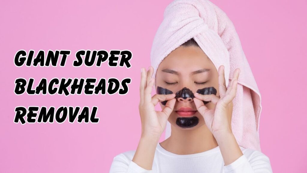 giant super blackheads removal