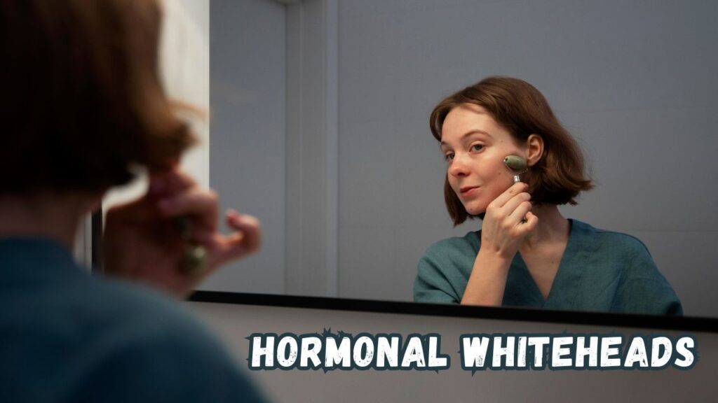 hormonal whiteheads