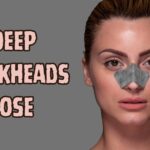 big deep blackheads on nose