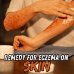 remedy for eczema on skin